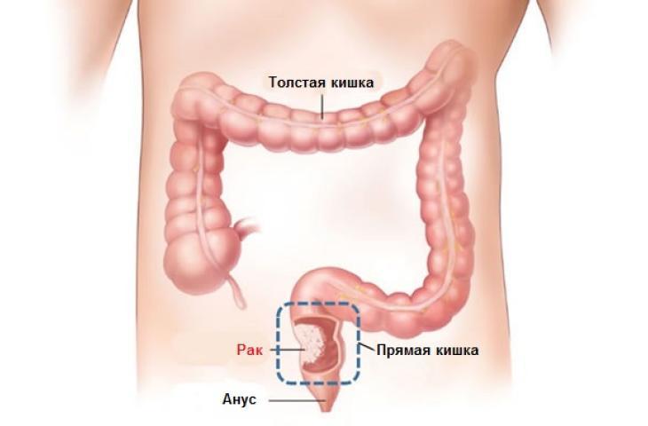 Рак прямой кишки