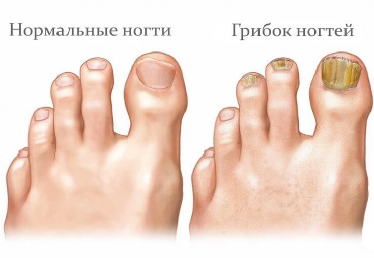 Грибок ногтей и стоп
