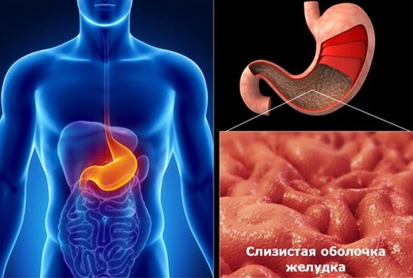 Острый гастрит