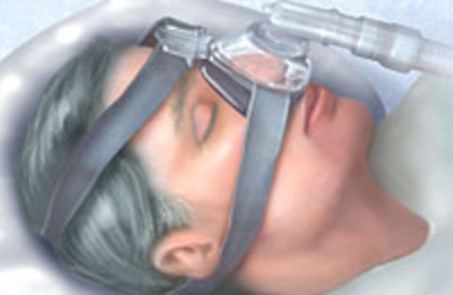 CPAP-терапия