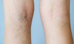 10 фактов о варикозе